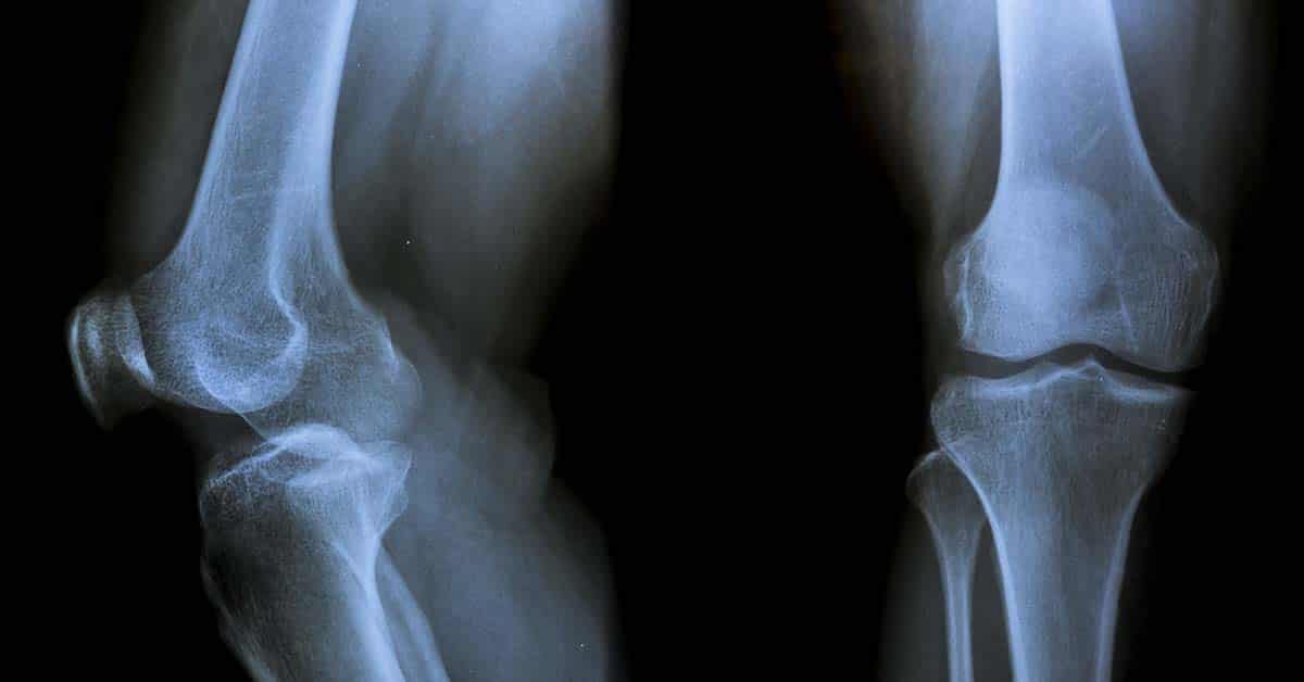 Ortopedista Especialista em Joelho Dr. Luiz Gabriel Atendimento de Alto Padrão em Ortopedia do Joelho. Realização de Cirurgias e Procedimentos. Experiência e Dedicação. Resultados Precisos. Diagnóstico de lesão no ligamento cruzado anterior: o que esperar do exame