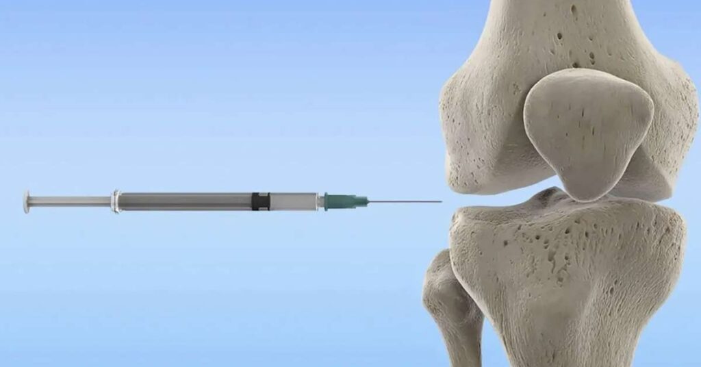 Ortopedista Especialista em Joelho Dr. Luiz Gabriel Atendimento de Alto Padrão em Ortopedia do Joelho. Realização de Cirurgias e Procedimentos. Experiência e Dedicação. Resultados Precisos. Infiltração do Joelho com ácido hialurônico Benefícios e cuidados