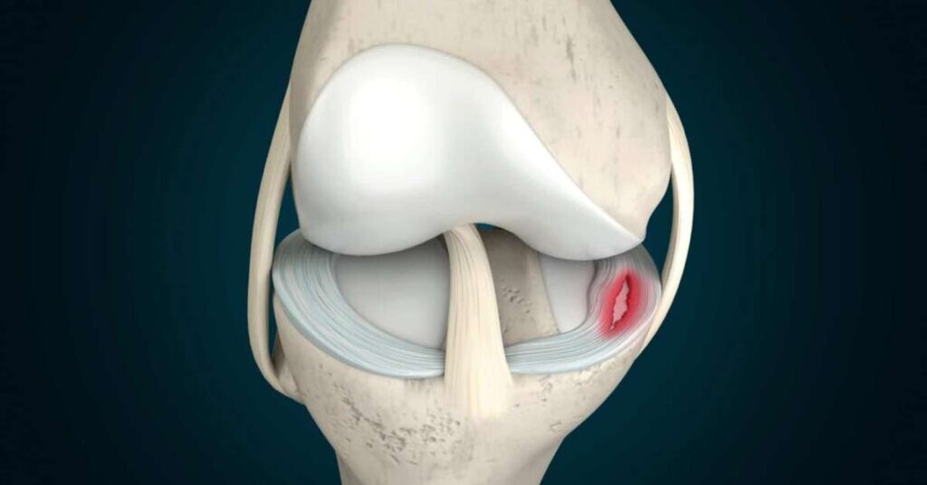 Ortopedista Especialista em Joelho Dr. Luiz Gabriel Atendimento de Alto Padrão em Ortopedia do Joelho. Realização de Cirurgias e Procedimentos. Experiência e Dedicação. Resultados Precisos. Imagem atual: Qual é a causa da Perimeniscite