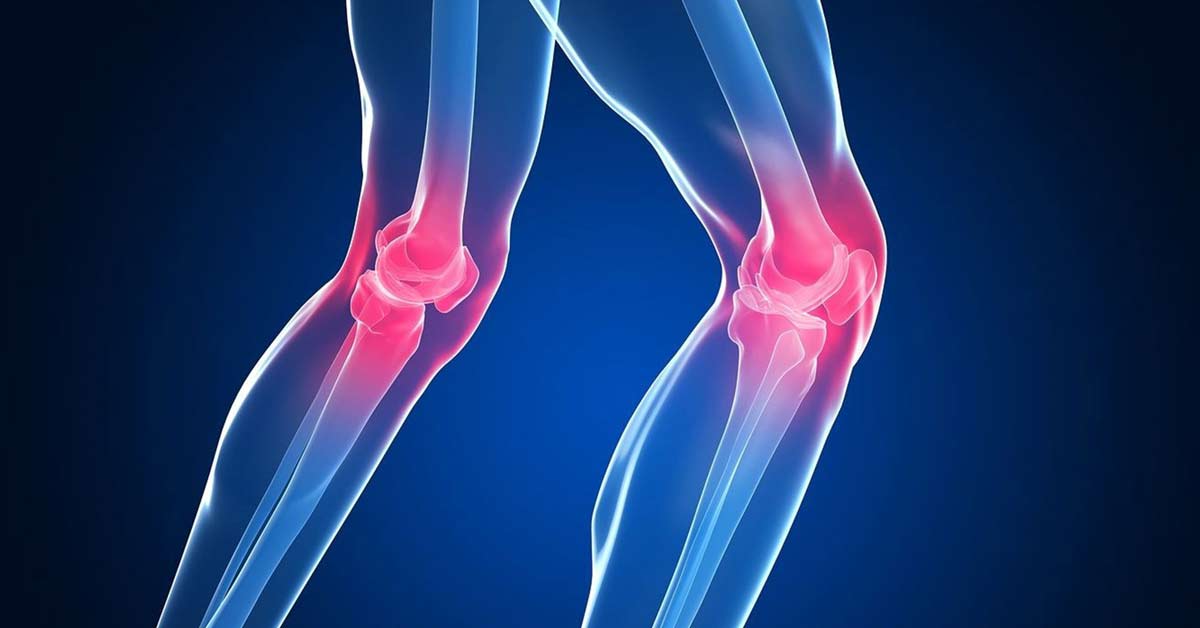 Artrose do Joelho: Causas, Fatores de Risco e Prevenção