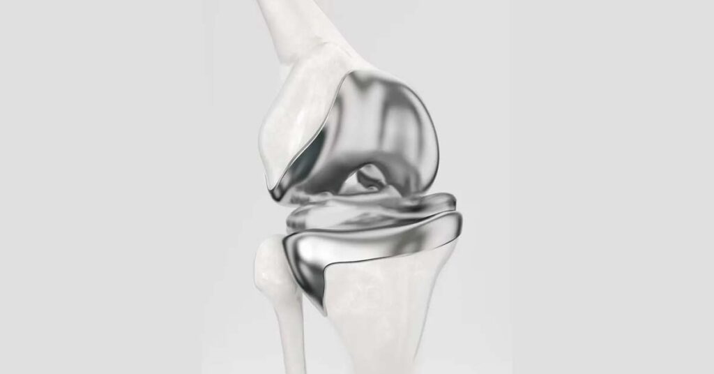 Evolução das Técnicas de Artroplastia