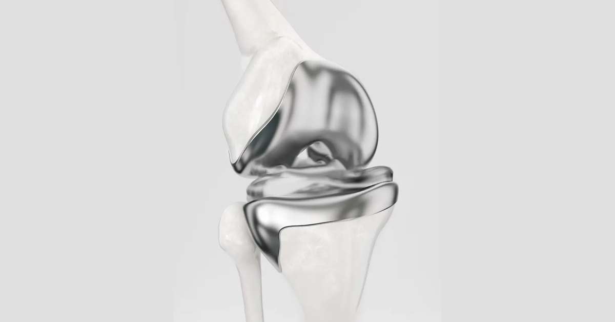 Ortopedista Especialista em Joelho Dr. Luiz Gabriel Atendimento de Alto Padrão em Ortopedia do Joelho. Realização de Cirurgias e Procedimentos. Experiência e Dedicação. Resultados Precisos. Artroplastia de joelho: etapas da cirurgia e recuperação